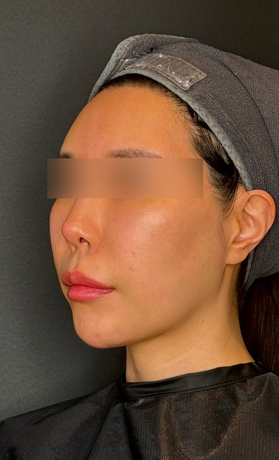 압토스 실리프팅 시술 전 정면에서 본 얼굴선 및 턱선 상태