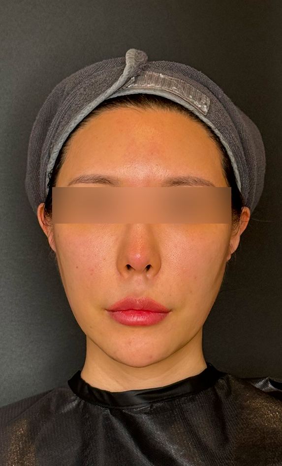 시술 전 볼 아래쪽 라인과 턱선이 둥글게 내려온 고민 부위
