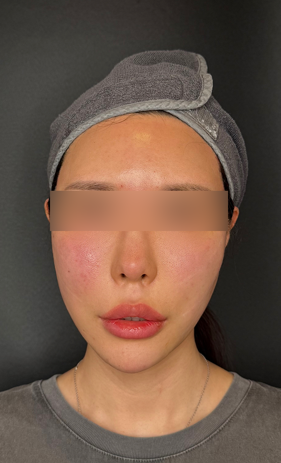 압토스 실리프팅 후 윤곽이 또렷해진 얼굴선 45도 측면